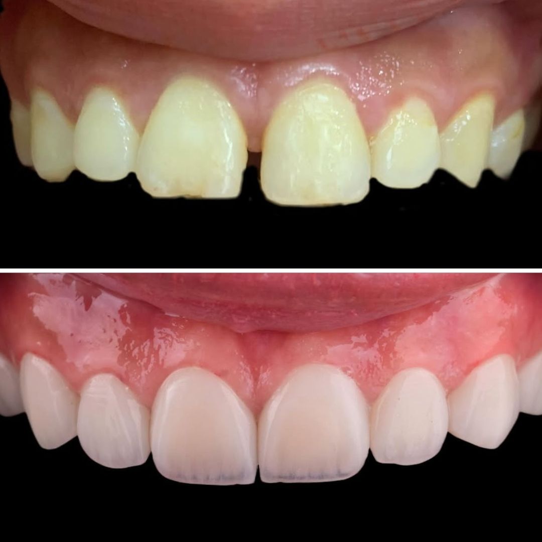 Clear Aligner (active Aligners and then Veneers natural-smile-enhancement-using-smile-club-premium-veneers