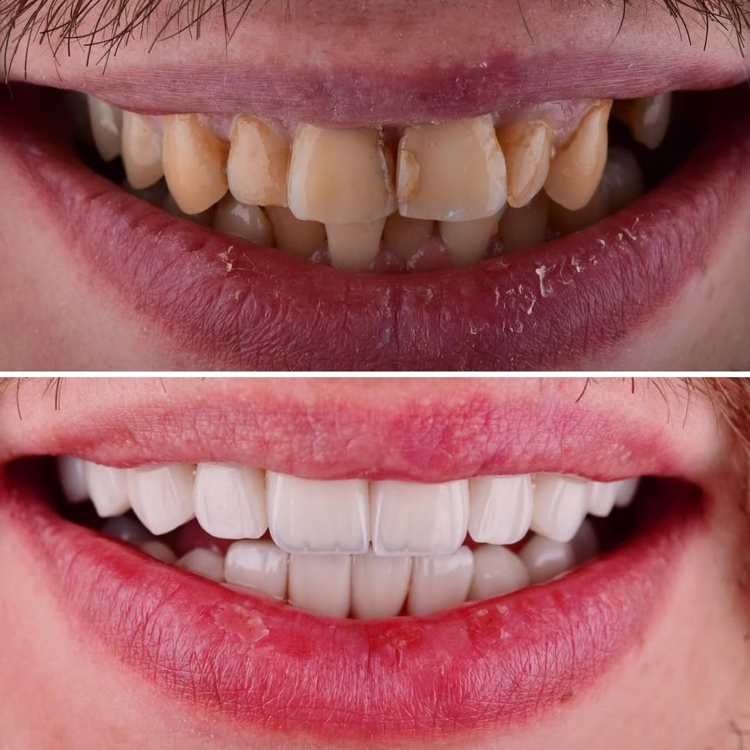 Smile Transformation with Smile Club Veneers and Active Smile Design