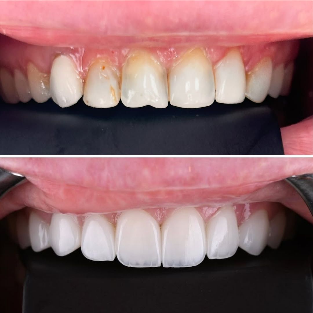 smile-enhancement-veneers-upper-front-teeth with smile club veneers