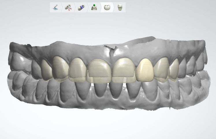 Digital dental wax up - Digital diagnostic wax up