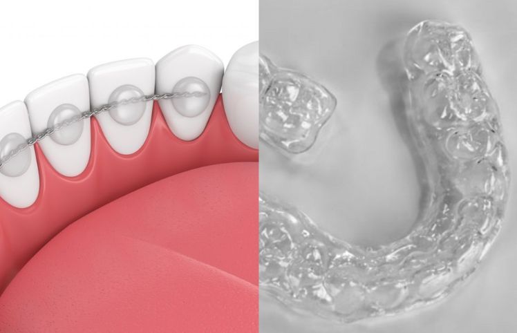 fixed lingual wire retainer or removable plastic retainer