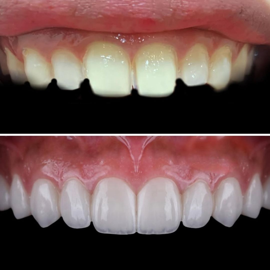 close-up-of-natural-smile-after-cosmetic-dentistry with smile club veneers minimal prep and active smile design