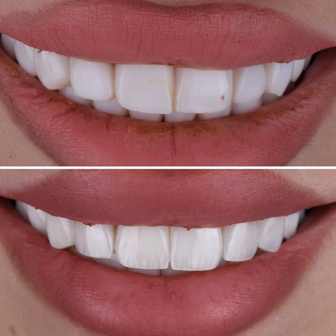 before-after-veneer-replacement-natural-aesthetic-restoration Active Smile Design