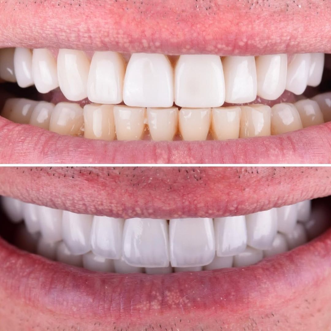 replacing-old-dental-veneers-with-smile-club-veneers and active smile design before and after replacing old veneers