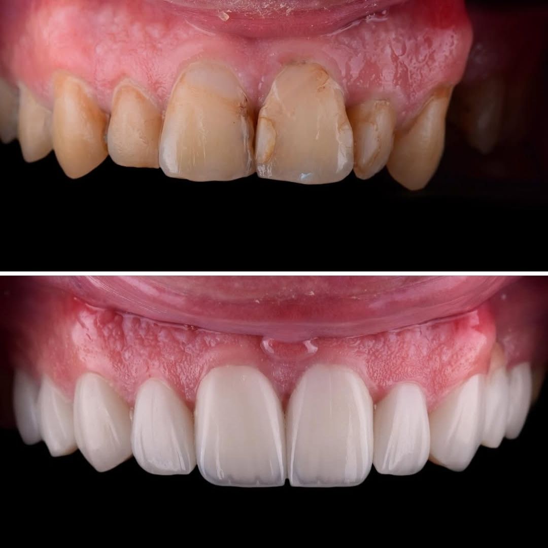 total smile transformation with smile club veneers and active smile design