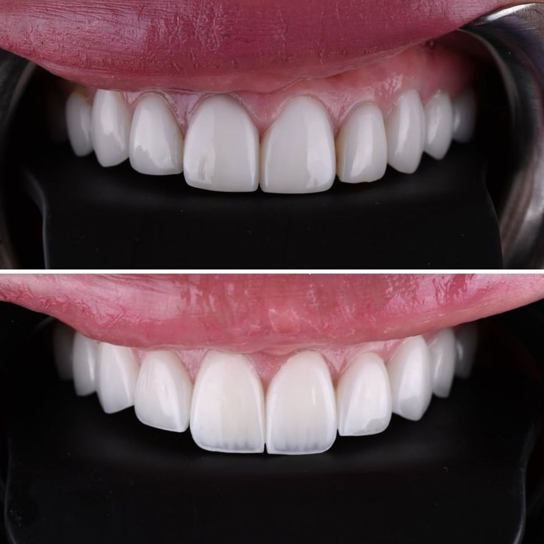 smile-transformation-from-old-veneers-to-new-porcelain-designed smile club premium veneers