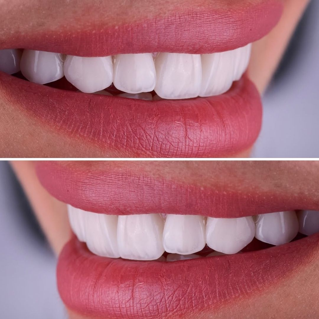 Smile Club Veneers total smile and teeth transformation Active Sile Design