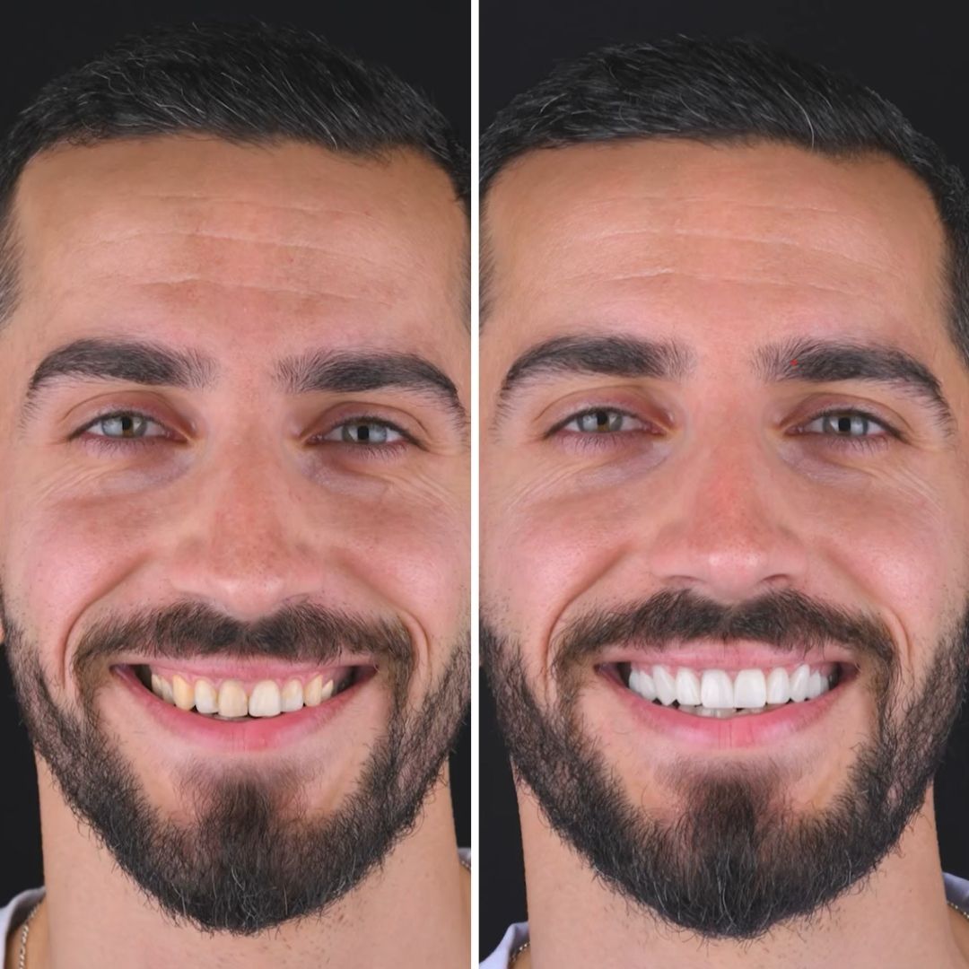 smile-club-premium-veneers-male-patient-full-face-smile-transformation with active smile design