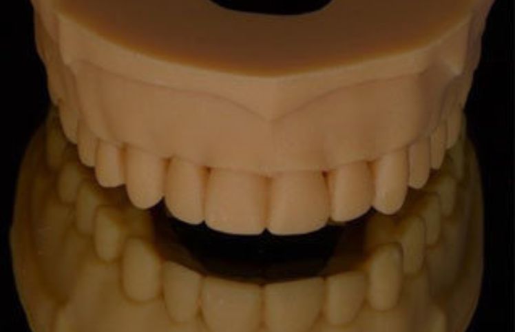 3D printed dental digital diagnostic model - smile design