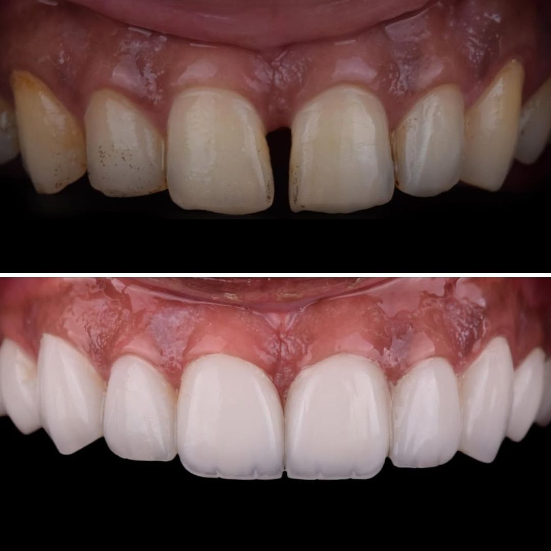 smile-club-premium-veneers-upper-arch-transformation-closing-spaces with porcelain veneers