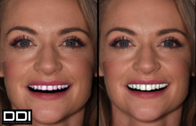 Active Smile Design - before and after - digital smile design.