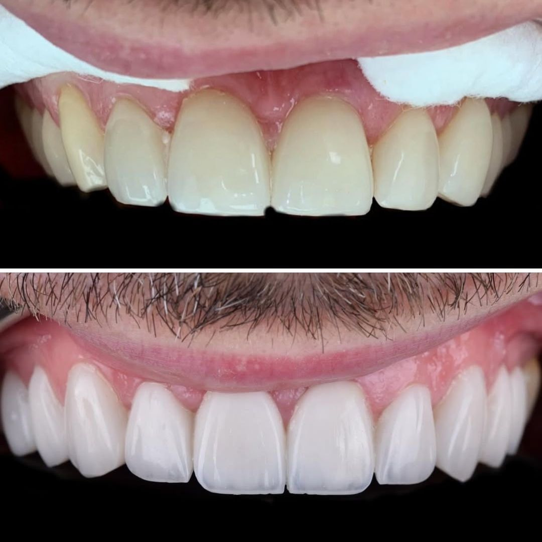 replacing composite bonding with porcelain veneers